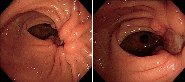 [Kalimate-Associated Gastric Ulcer].