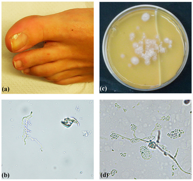 First Confirmed Description of <i>Acremonium egyptiacum</i> from Greece and Molecular Identification of <i>Acremonium</i> and <i>Acremonium</i>-like Clinical Isolates.