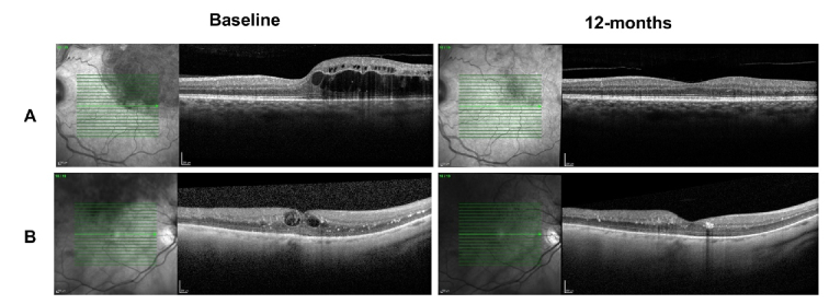 Predictive Factors for Functional and Anatomical Outcomes After Anti-VEGF Treatment for Macular Edema in Patients with Branch Retinal Vein Occlusion.
