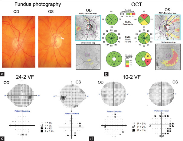 Central visual field in glaucoma: An updated review.