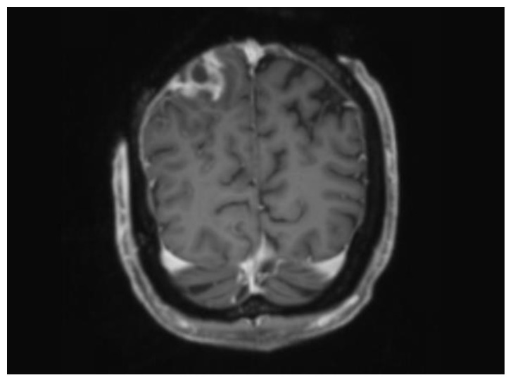 High-Voltage Electrical Burn Requiring Urgent Scalp Reconstruction after Developing a Brain Abscess.