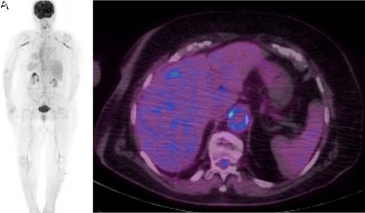 Clinical Phenotypes of Giant Cell Arteritis: Insights into Complications and Survival Outcomes.