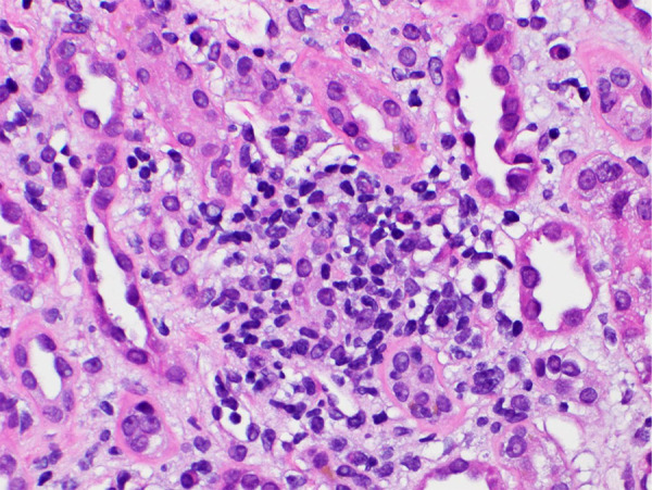 A rare case of alirocumab (PCSK9 inhibitor)-associated acute interstitial nephritis.