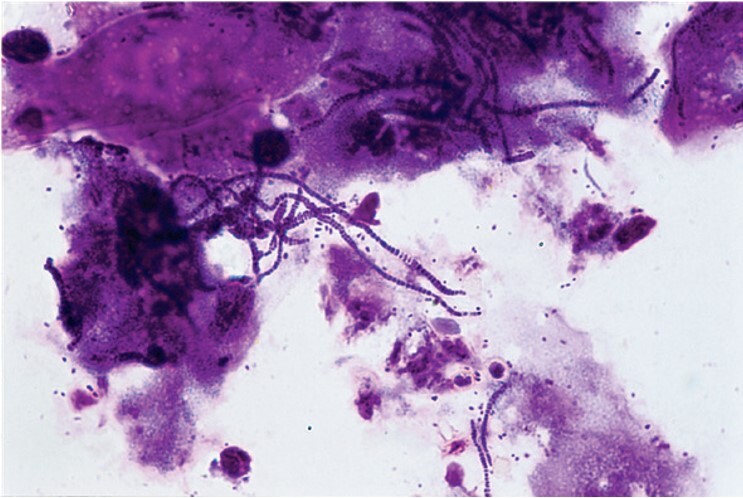 Outbreak of dermatophilosis in horses possibly transmitted by sharing riding equipment.