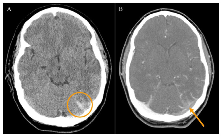 Central Venous Thrombosis Presenting with an Unknown Etiology: A Case Report.