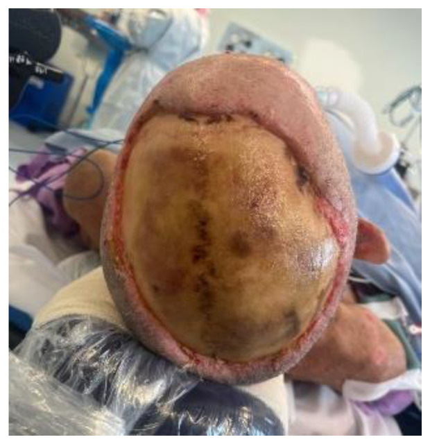 High-Voltage Electrical Burn Requiring Urgent Scalp Reconstruction after Developing a Brain Abscess.
