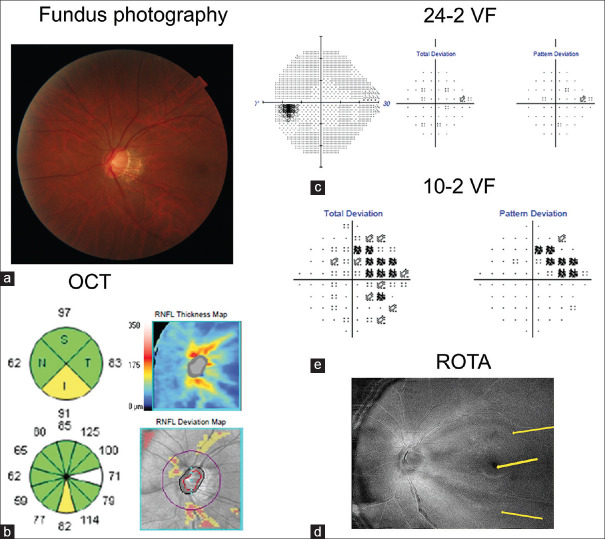 Central visual field in glaucoma: An updated review.