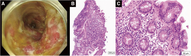 A Case of Acute Aortic Occlusion Occurring in Association with COVID-19 Infection and Ulcerative Colitis.