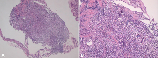 [Kalimate-Associated Gastric Ulcer].