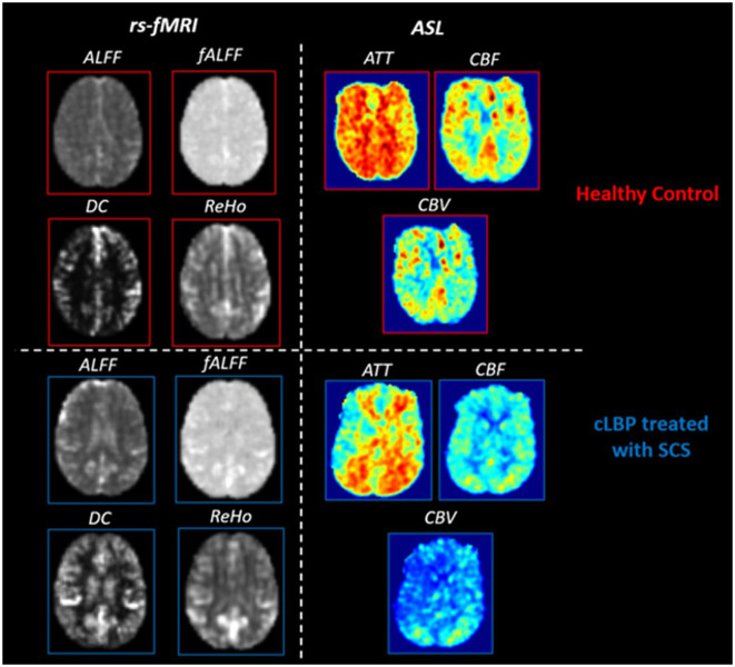 Multimodal functional imaging and clinical correlates of pain regions in chronic low-back pain patients treated with spinal cord stimulation: a pilot study.