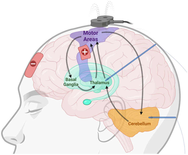 Beyond Pallidal or Subthalamic Deep Brain Stimulation to Treat Dystonia.