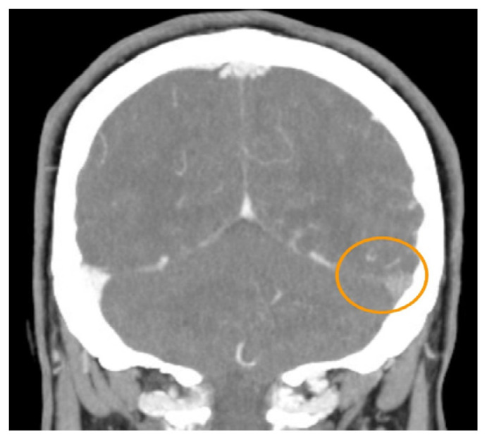 Central Venous Thrombosis Presenting with an Unknown Etiology: A Case Report.