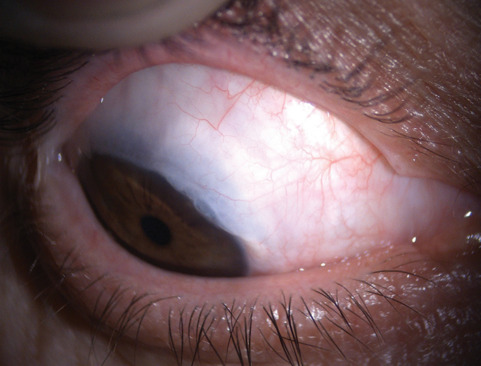 Diagnosis and treatment of spontaneous filtering bleb: A case report.