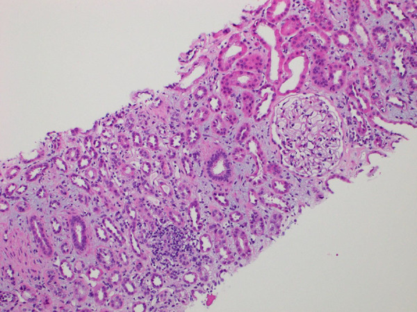 A rare case of alirocumab (PCSK9 inhibitor)-associated acute interstitial nephritis.