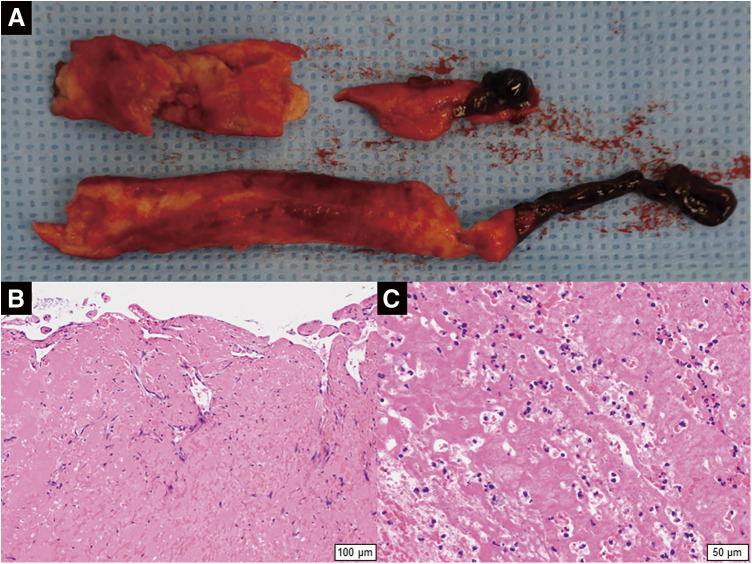 A Case of Acute Aortic Occlusion Occurring in Association with COVID-19 Infection and Ulcerative Colitis.