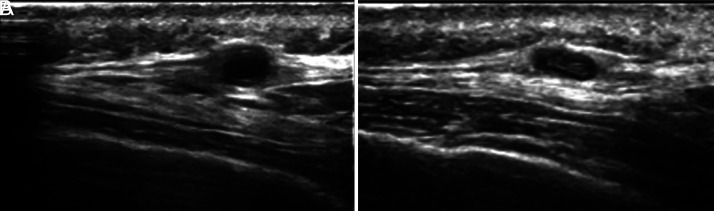 Clinical Phenotypes of Giant Cell Arteritis: Insights into Complications and Survival Outcomes.