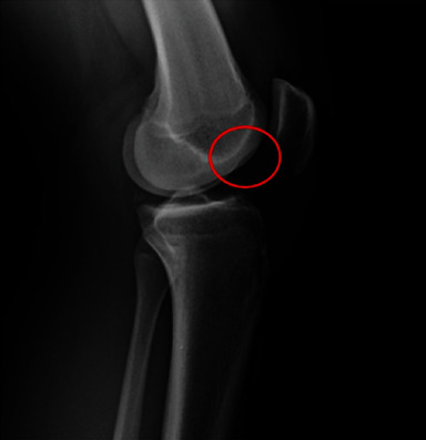 Acute Bilateral Posterior Meniscal Root Tears in the Setting of a Noncontact Anterior Cruciate Ligament Rupture.