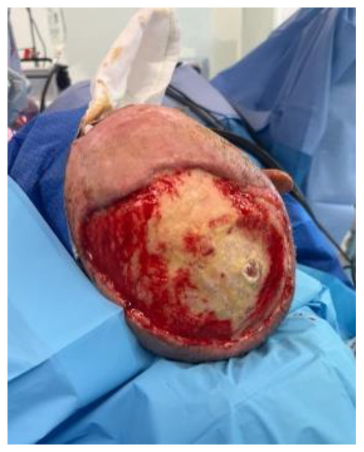 High-Voltage Electrical Burn Requiring Urgent Scalp Reconstruction after Developing a Brain Abscess.