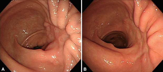 [Kalimate-Associated Gastric Ulcer].