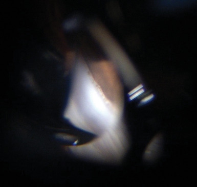 Diagnosis and treatment of spontaneous filtering bleb: A case report.