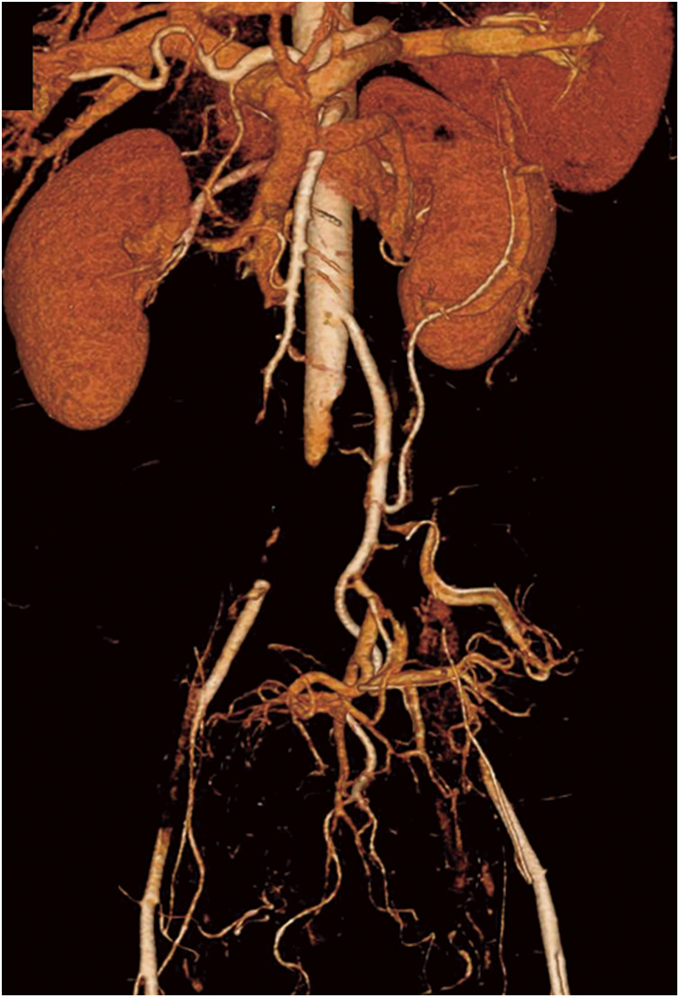 A Case of Acute Aortic Occlusion Occurring in Association with COVID-19 Infection and Ulcerative Colitis.