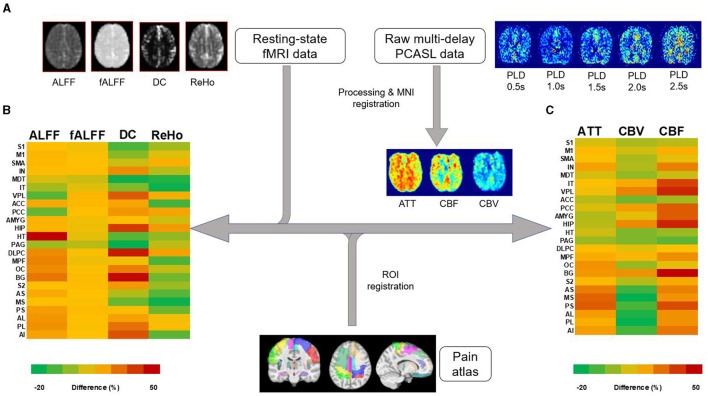 Multimodal functional imaging and clinical correlates of pain regions in chronic low-back pain patients treated with spinal cord stimulation: a pilot study.