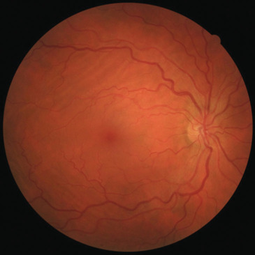 Diagnosis and treatment of spontaneous filtering bleb: A case report.