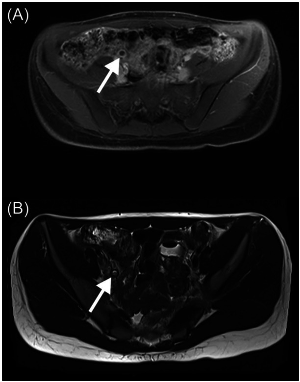 Endoscopic diagnosis of asymptomatic appendicitis in a pediatric patient.