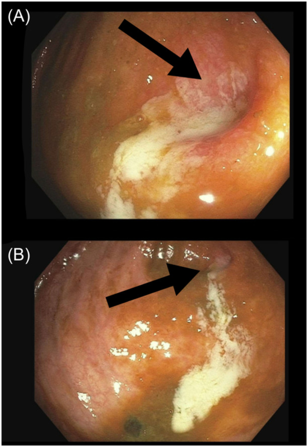Endoscopic diagnosis of asymptomatic appendicitis in a pediatric patient.