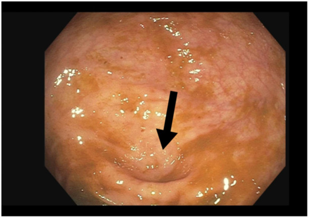Endoscopic diagnosis of asymptomatic appendicitis in a pediatric patient.