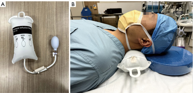 Computer-assisted navigation of anterior odontoid screw fixation for type II odontoid fracture: case report and practical positioning technique.
