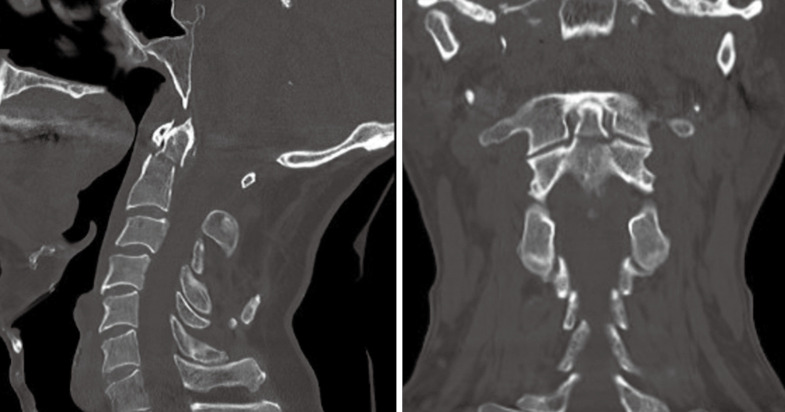 Computer-assisted navigation of anterior odontoid screw fixation for type II odontoid fracture: case report and practical positioning technique.