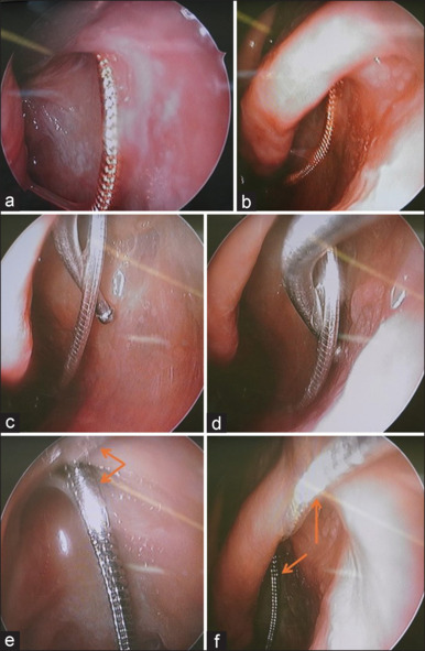 A Novel Snake-chain Metal Probed Silicon Intubation Set for Nasolacrimal Duct Intubation: A Cadaveric Feasibility Study.