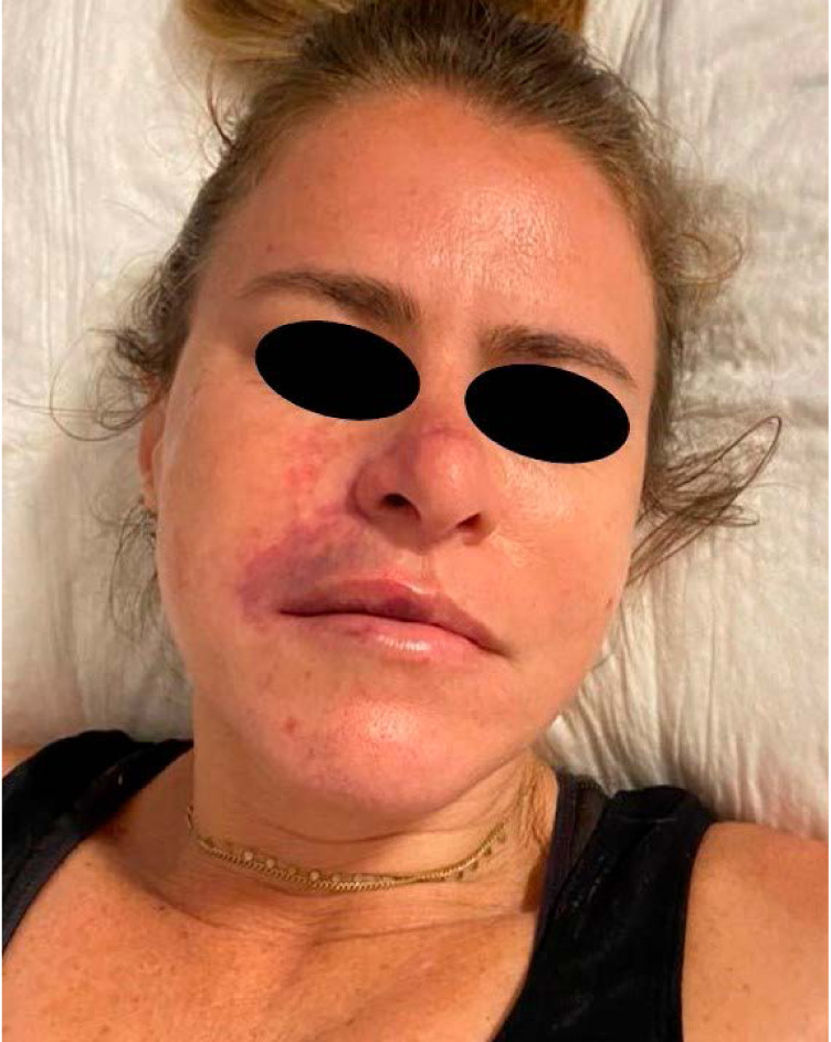 Ultrasonography in the management of lip complications caused by hyaluronic acid.