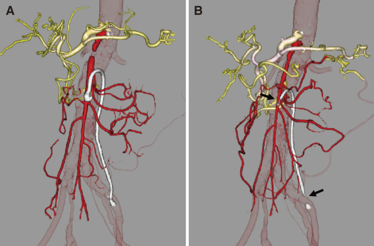 Revision Surgery for Venous Graft Stenosis of SMA Bypass.