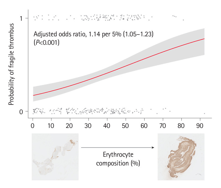 Thrombi With a Higher Erythrocyte Composition Are More Fragile in Acute Stroke.