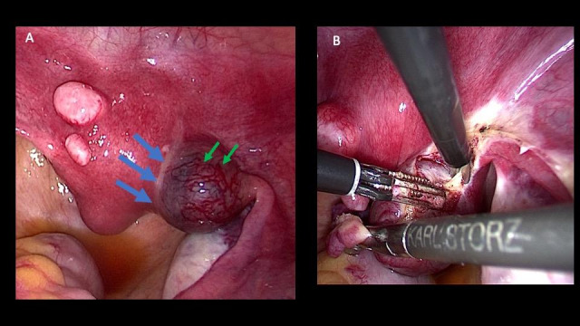 Laparoscopic cornual resection for interstitial pregnancy: Staying in the Marginal Zone.