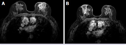 Relationship of post-treatment radiological findings with relapses in idiopathic granulomatous mastitis patients.