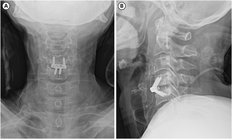 Oral Extrusion of a Screw After Anterior Cervical Spine Plating: A Case Report.