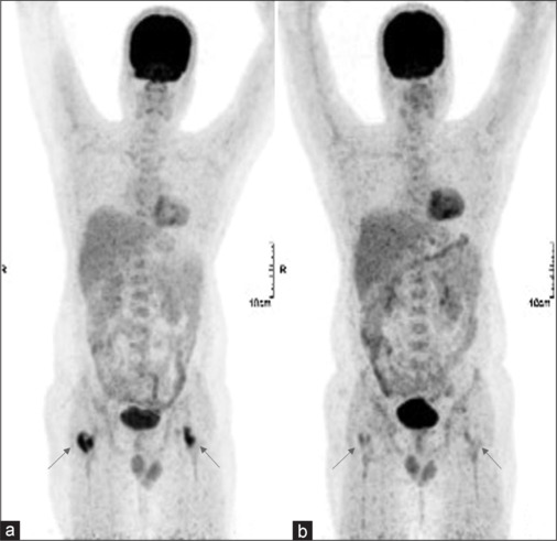 [18F]FDG- PET/CT in Diagnosis, Staging, and Management of Patients with Langerhans Cell Histiocytosis.