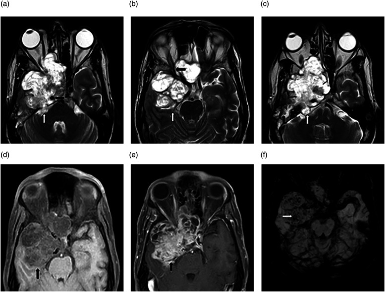 Invasive trigeminal ganglioneuroma: A case report and review of the literature.