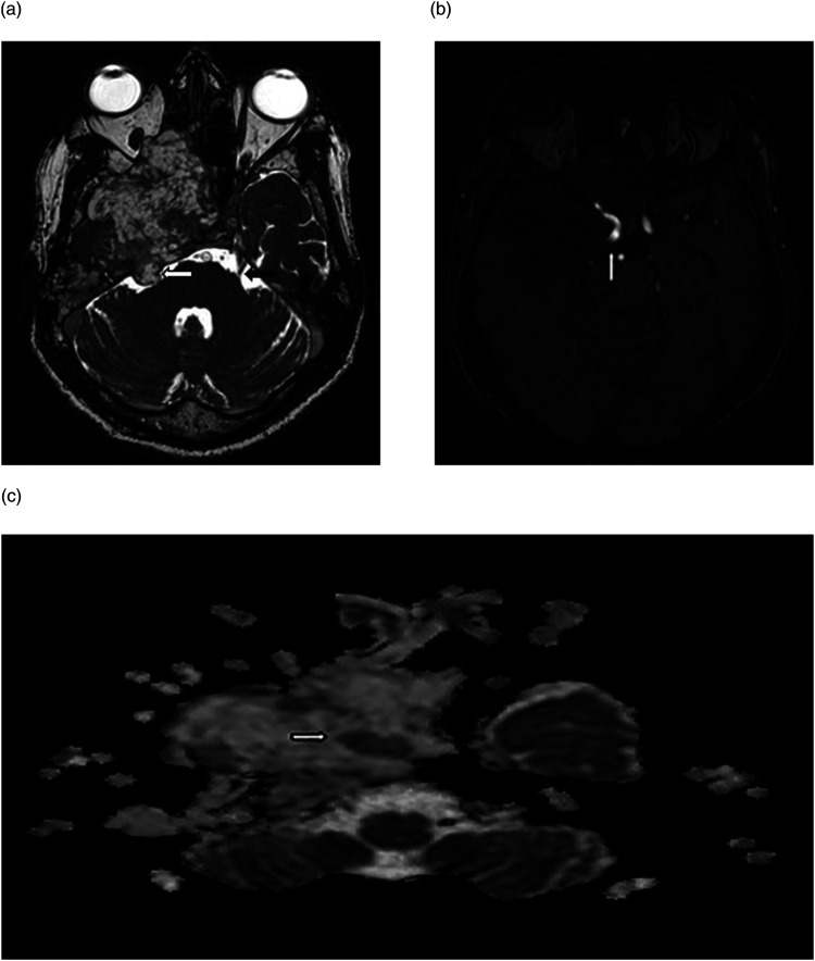 Invasive trigeminal ganglioneuroma: A case report and review of the literature.