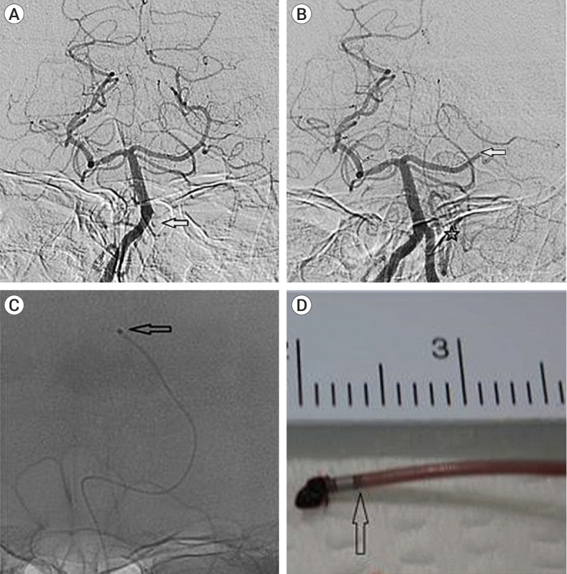 Suction thrombectomy of distal medium vessel occlusion using microcatheter during mechanical thrombectomy for acute ischemic stroke: A case series.
