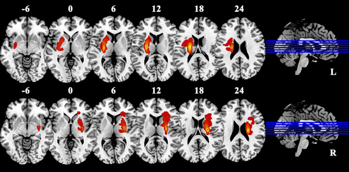A comparative study of interhemispheric functional connectivity in patients with basal ganglia ischemic stroke.