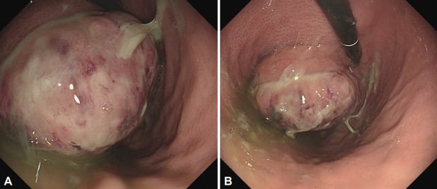 [Gastric Undifferentiated Pleomorphic Sarcoma Presenting as a Rapidly Growing Subepithelial Tumor].