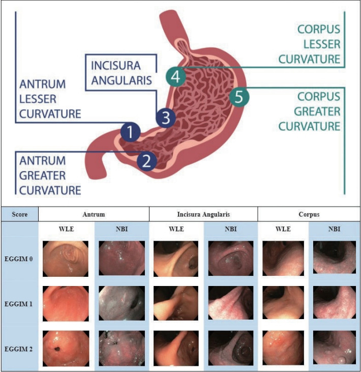Chronic Atrophic Gastritis and Intestinal Metaplasia: A Latin American Perspective.