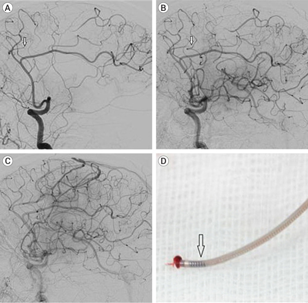Suction thrombectomy of distal medium vessel occlusion using microcatheter during mechanical thrombectomy for acute ischemic stroke: A case series.