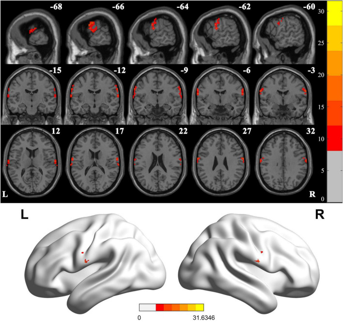A comparative study of interhemispheric functional connectivity in patients with basal ganglia ischemic stroke.