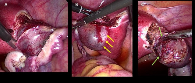 Laparoscopic cornual resection for interstitial pregnancy: Staying in the Marginal Zone.
