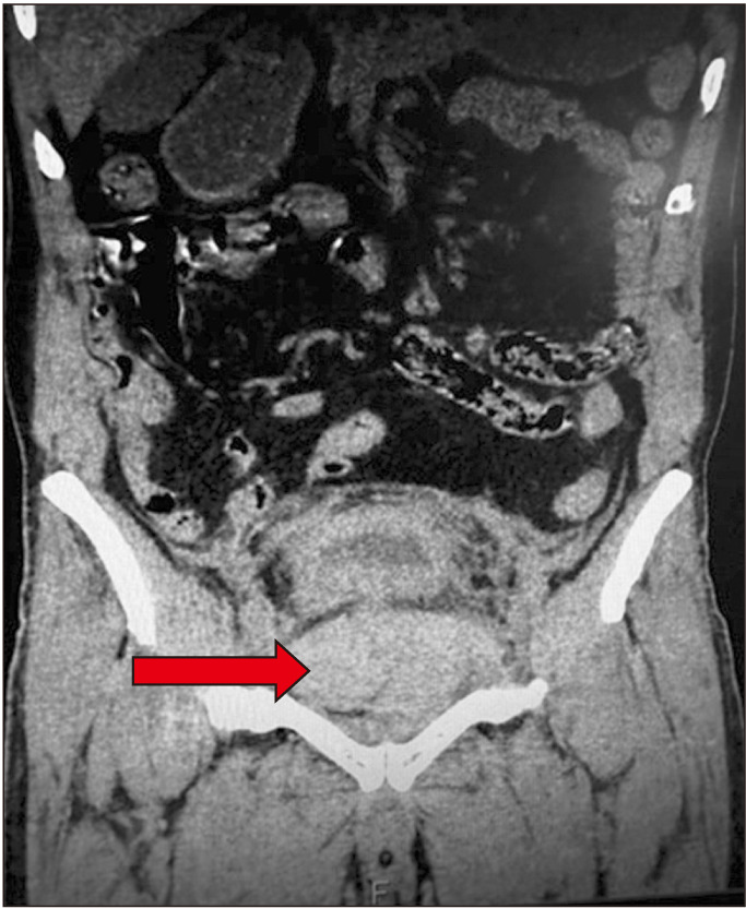 Pelvic hematoma post prostatic urethral lift: A need to be vigilant in high-risk patients.